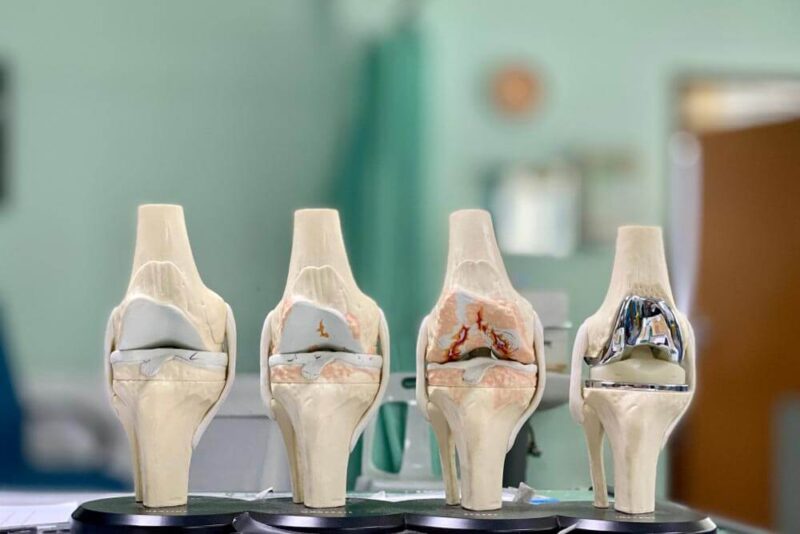 Kinematic Alignment Knee Replacement | Lansing, MI | David So, MD